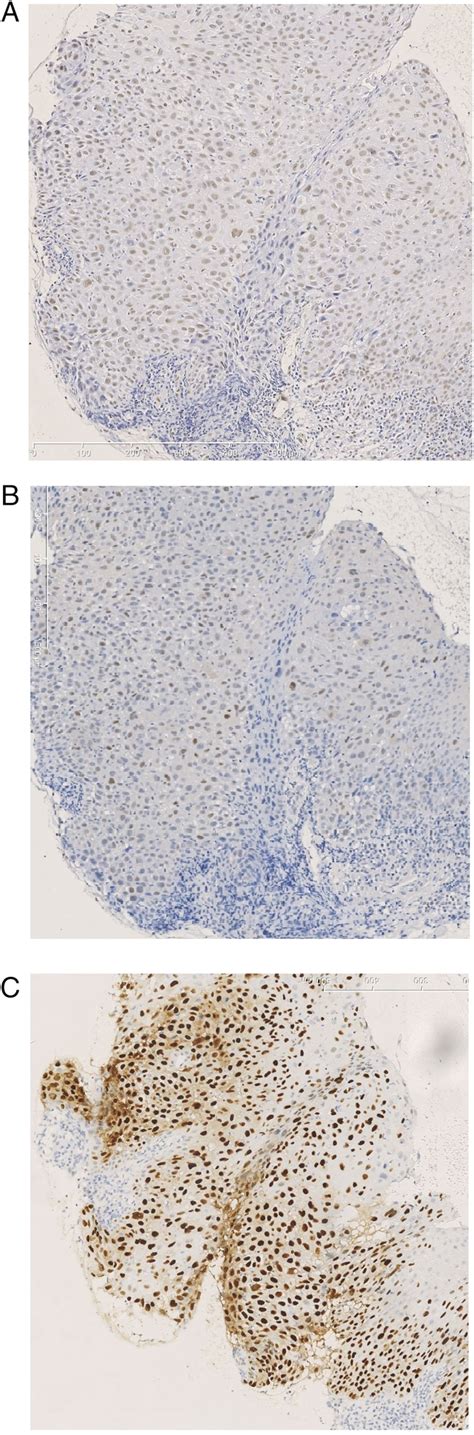 patm high|High pATM is Associated With Poor Local Control in Supraglottic .